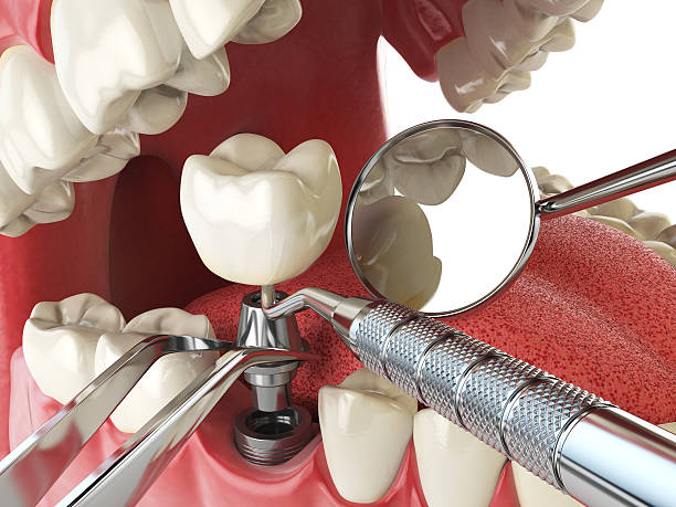 Best Emergency Root Canal Treatment in Loch Lomond, VA